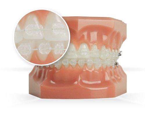 six-month smile teeth straightening - Dental at MediaCityUK