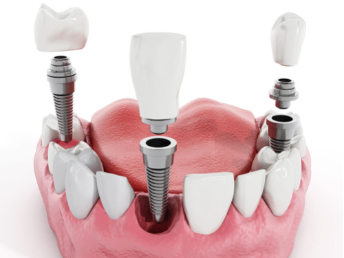 Trium-pic_672x386-3 Multiple teeth dental implant - Dental at MediaCityUK