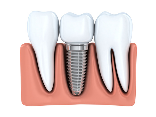 Trium-pic_672x386 single tooth dental implant - Dental at MediaCityUK